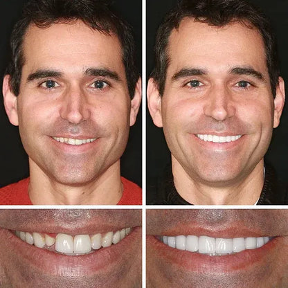 💥LAST DAY 50% OFF! Custom-Fit Instant Smile Dentures – Ultra Natural Appearance, Custom Comfort Fit You’ll Love