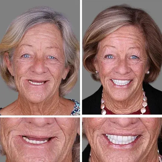 💥LAST DAY 50% OFF! Custom-Fit Instant Smile Dentures – Ultra Natural Appearance, Custom Comfort Fit You’ll Love