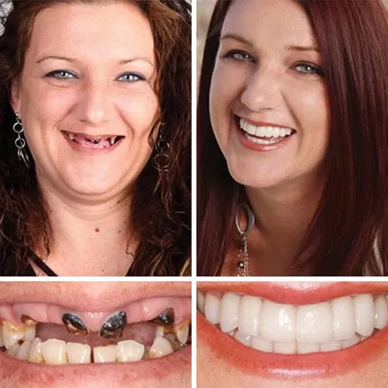 💥LAST DAY 50% OFF! Custom-Fit Instant Smile Dentures – Ultra Natural Appearance, Custom Comfort Fit You’ll Love