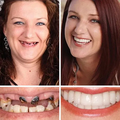 💥LAST DAY 50% OFF! Custom-Fit Instant Smile Dentures – Ultra Natural Appearance, Custom Comfort Fit You’ll Love