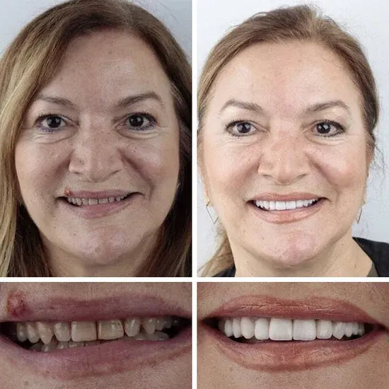💥LAST DAY 50% OFF! Custom-Fit Instant Smile Dentures – Ultra Natural Appearance, Custom Comfort Fit You’ll Love